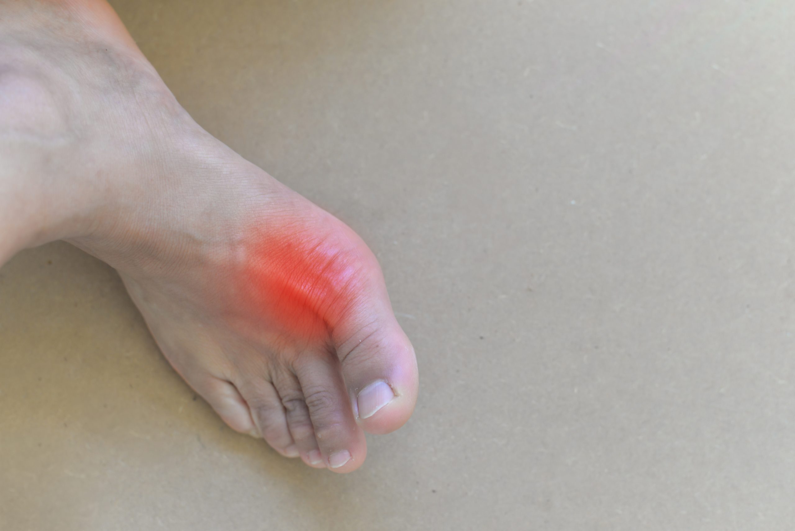 Painful and inflamed gout.