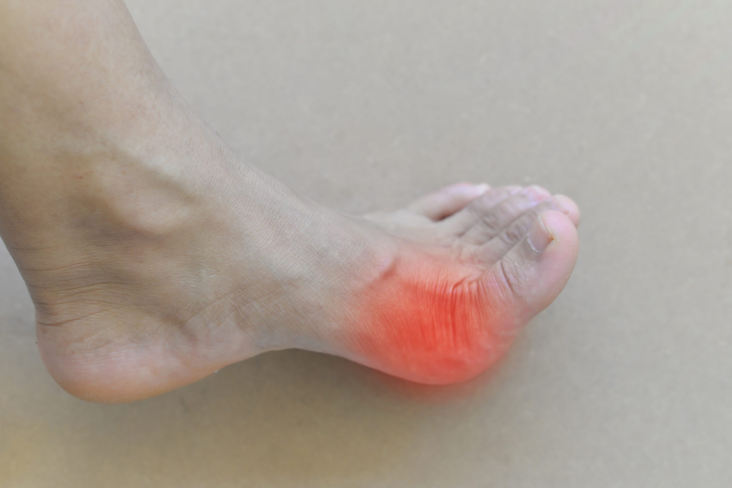 Painful and inflamed gout.